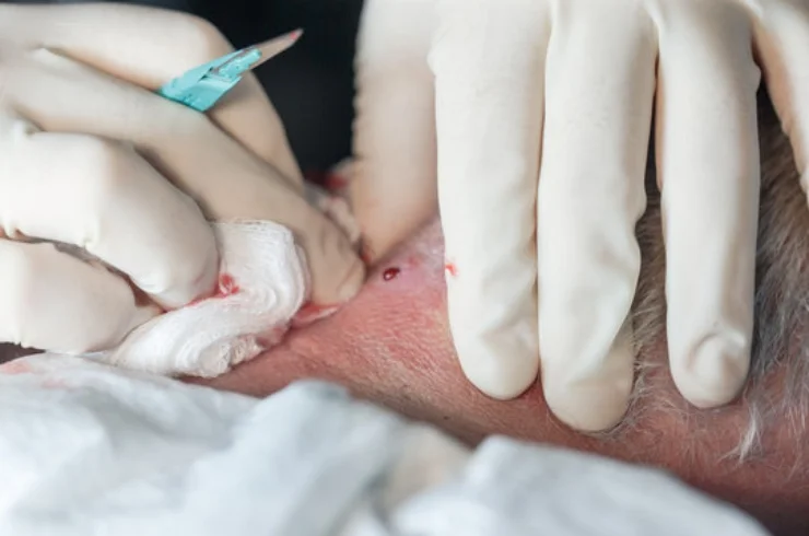 Sebaceous Cyst Excision